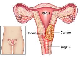 Natural Remedies For Cervical Cancer