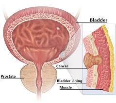 Treatment Of Bladder Cancer