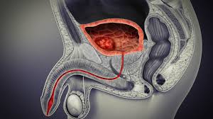 Treatment Of Bladder Cancer