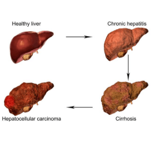 detoxify your liver naturally